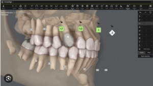 A Revolução do Diagnóstico Ortodôntico: A Importância da Tomografia nos Planejamentos Virtuais com Alinhadores